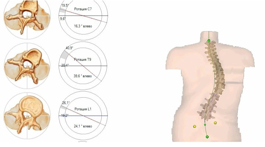 Поворот позвонков. Сколиоз с ротацией позвонков. Ротация позвонков при сколиозе 1 степени. Степени ротации тел позвонков рентген. Ротация позвонка на рентгене.
