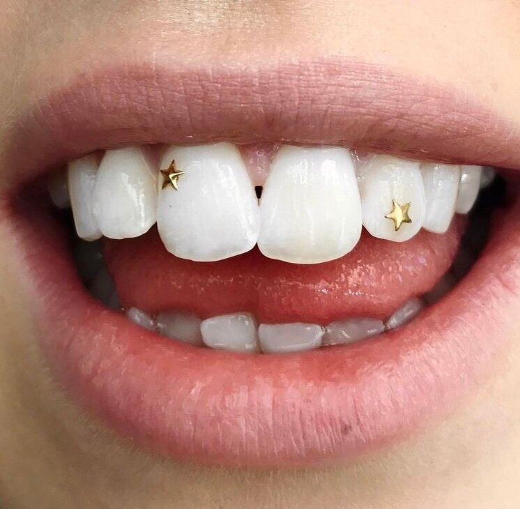 Стразы и даже бриллиантики на «двоечках» были популярны у нас пару-тройку лет назад. Мы ничего не имели против и активно «клеили» их пациентам.