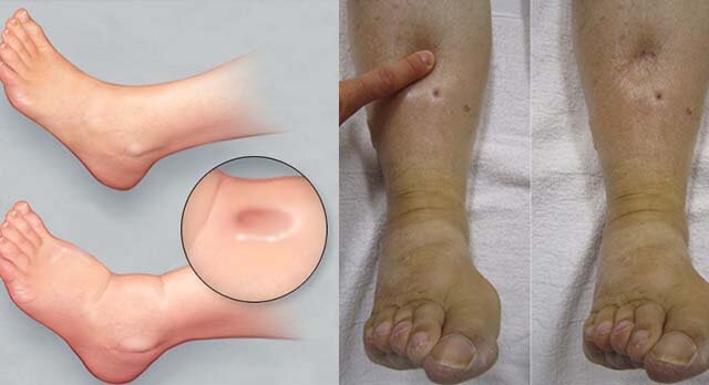 Пастозность у пациента с ХСН