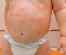 Аллергия на коже: симптомы и причины | Диагностика и лечение кожной аллергии в АО «Медицина»