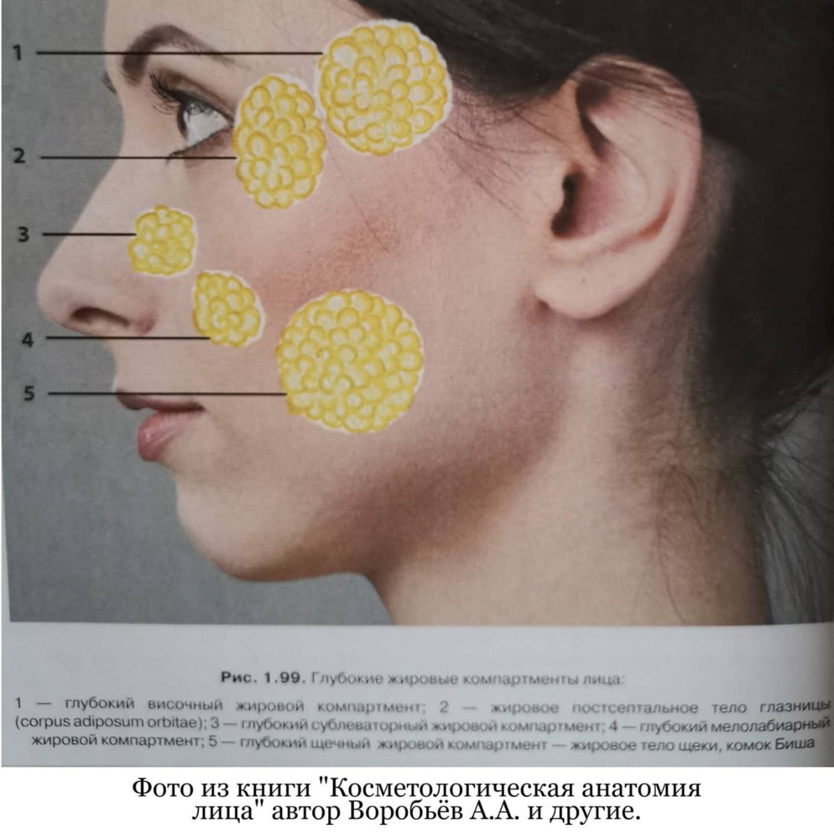 Жировая ткань лица. Жировой комок щеки (Биша) и. Комочки Биша расположение.