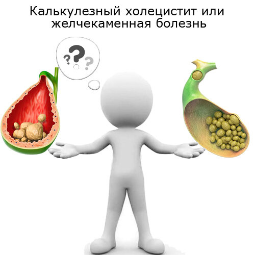 желчекаменная болезнь или калькулезный холецистит