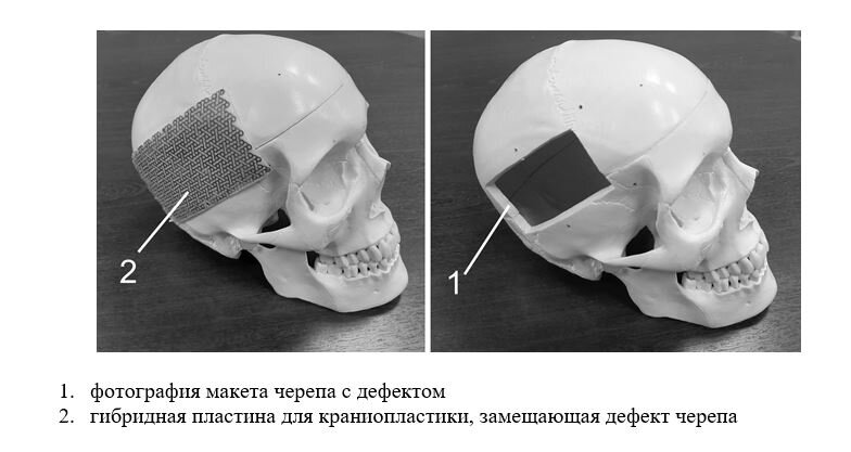 Краниопластика — это хирургическая процедура, при которой восстанавливается костный дефект или деформация черепа, что может быть достигнуто с помощью черепных имплантатов. Реконструкция таких дефектов в основном выполняется для восстановления структуры и функции отсутствующей черепной кости. Точно изготовленная черепная кость имеет решающее значение для обеспечения биомеханической защиты подлежащих мягких тканей головного мозга, а также для нормализации внутричерепного давления и восстановления показателей динамики кровотока спинномозговой жидкости.