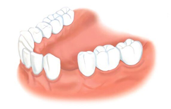 Протезирование зубов без обточки