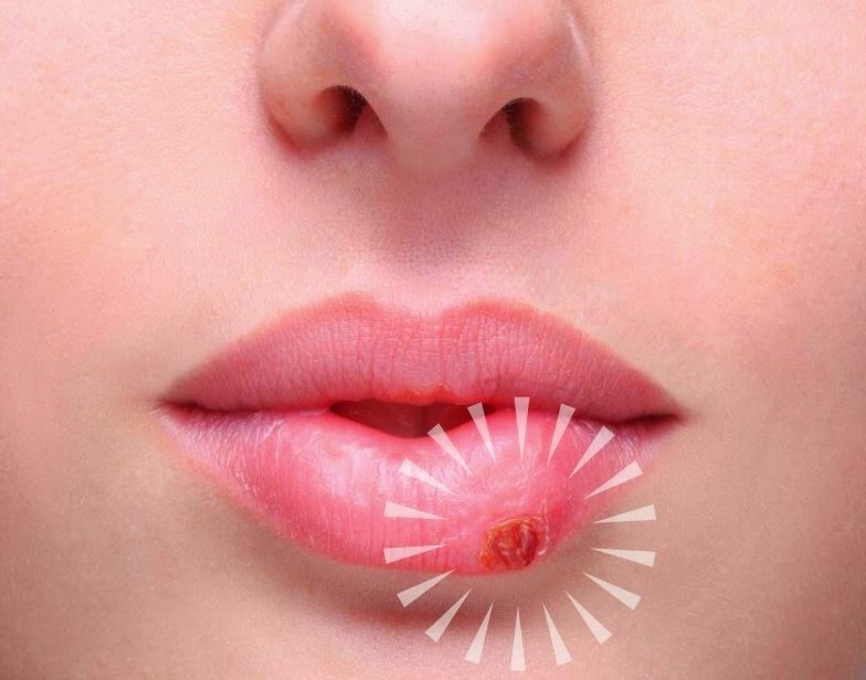 Герпес HSV-1 (ВПГ-1) или «простуда на губах»