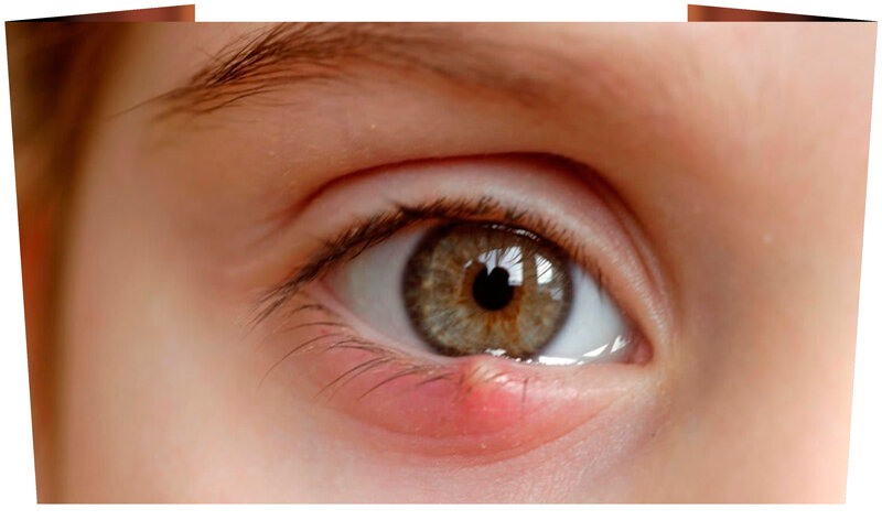 Ячмень - это одна из самых неприятных заболеваний глаз, что подтвердит каждый, кто им болел. Появляется в результате атаки бактерии стафилококка и, как следствие, воспаление.