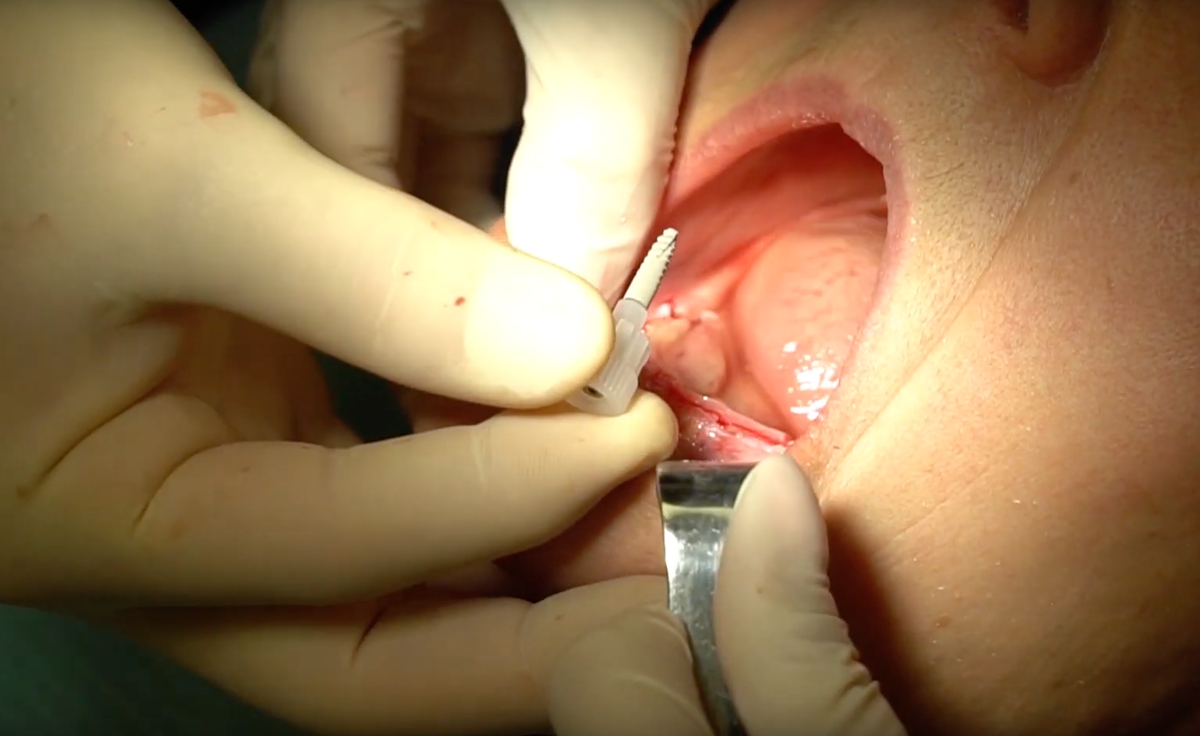 Установка имплантата