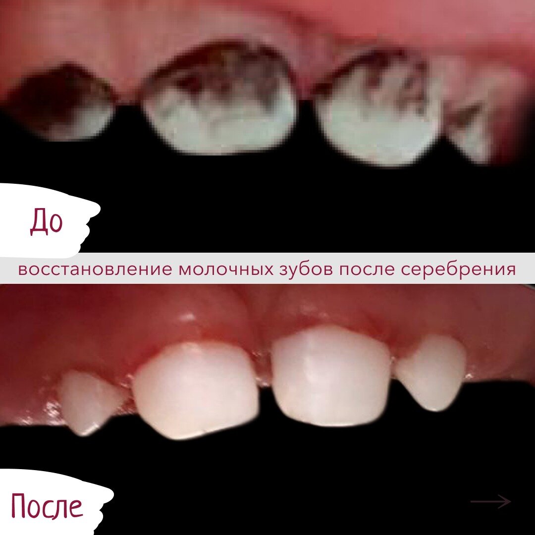 Серебрение Зубов Детям- Киев Цена, Фото До После- ЛюмиДент