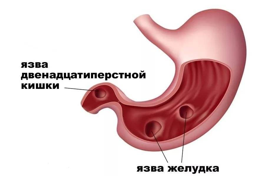 Язвенная болезнь желудка и двенадцатиперстной кишки. Язвенная болезнь желудка и 12 перстной. Язва желудка ( язвенная болезнь желудка ). Язвенная болезнь 12 перстной кишки.