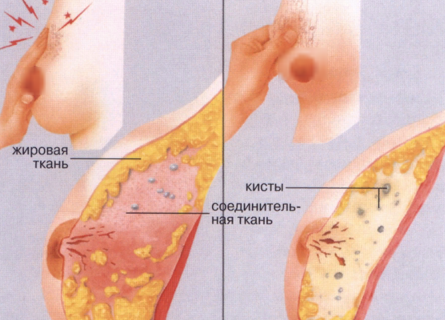 Диффузная фиброзно-кистозная мастопатия