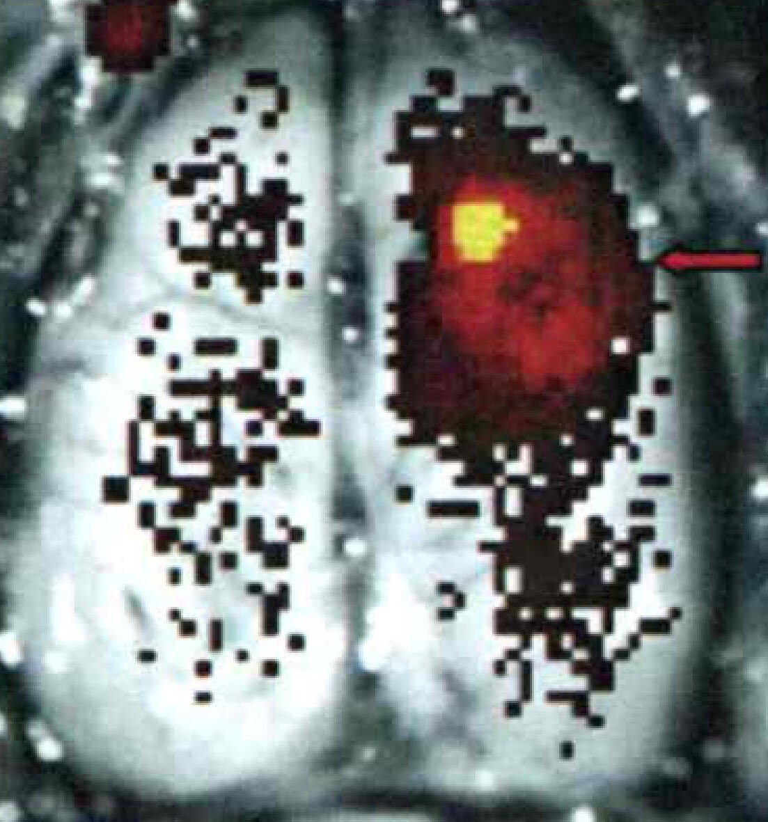 Рис. 1. Успешное обнаружение локализации раковых клеток «in vivo» в мозге мыши с использованием квантовых точек как люминесцентных меток.