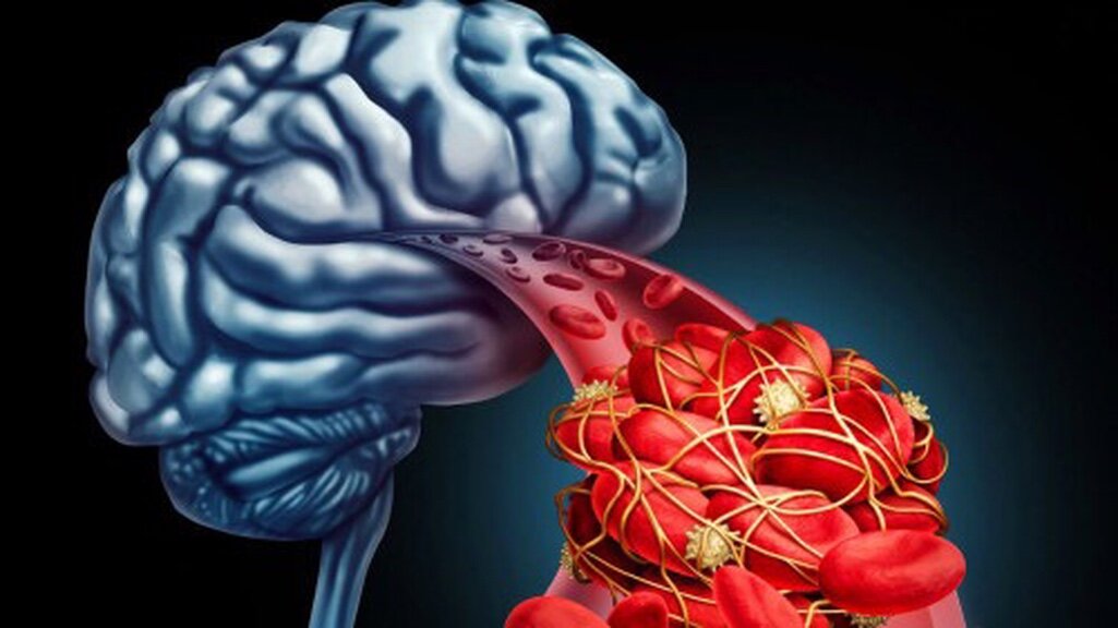 От каких продуктов и привычек следует отказаться для предотвращения инфаркта мозга. Фото: pixabay.com