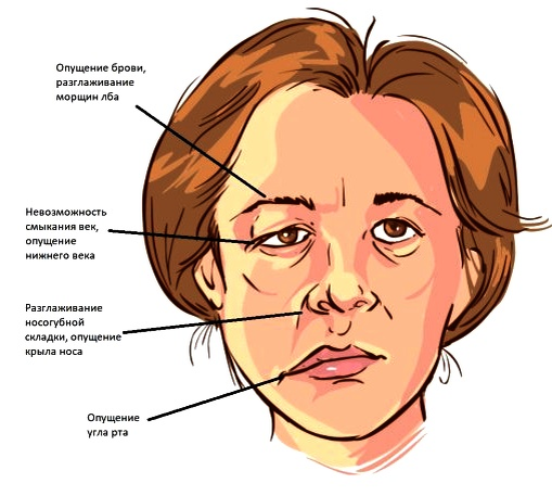 Нарушения, вызываемые параличом лицевого нерва