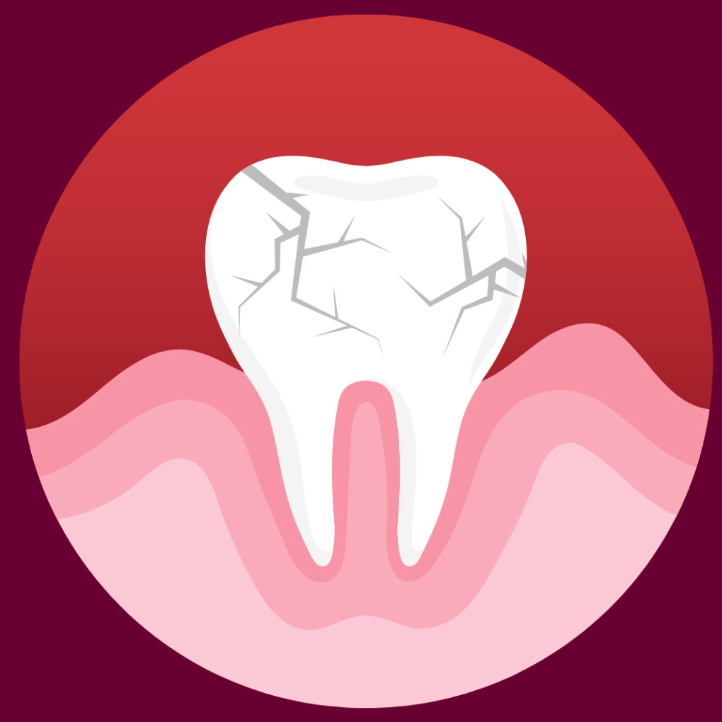 Почему крошатся зубы: причины и лечение