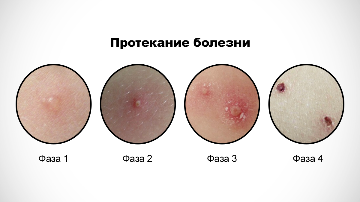 Чем опасна ветряная оспа? | Доктор Молодой | Дзен