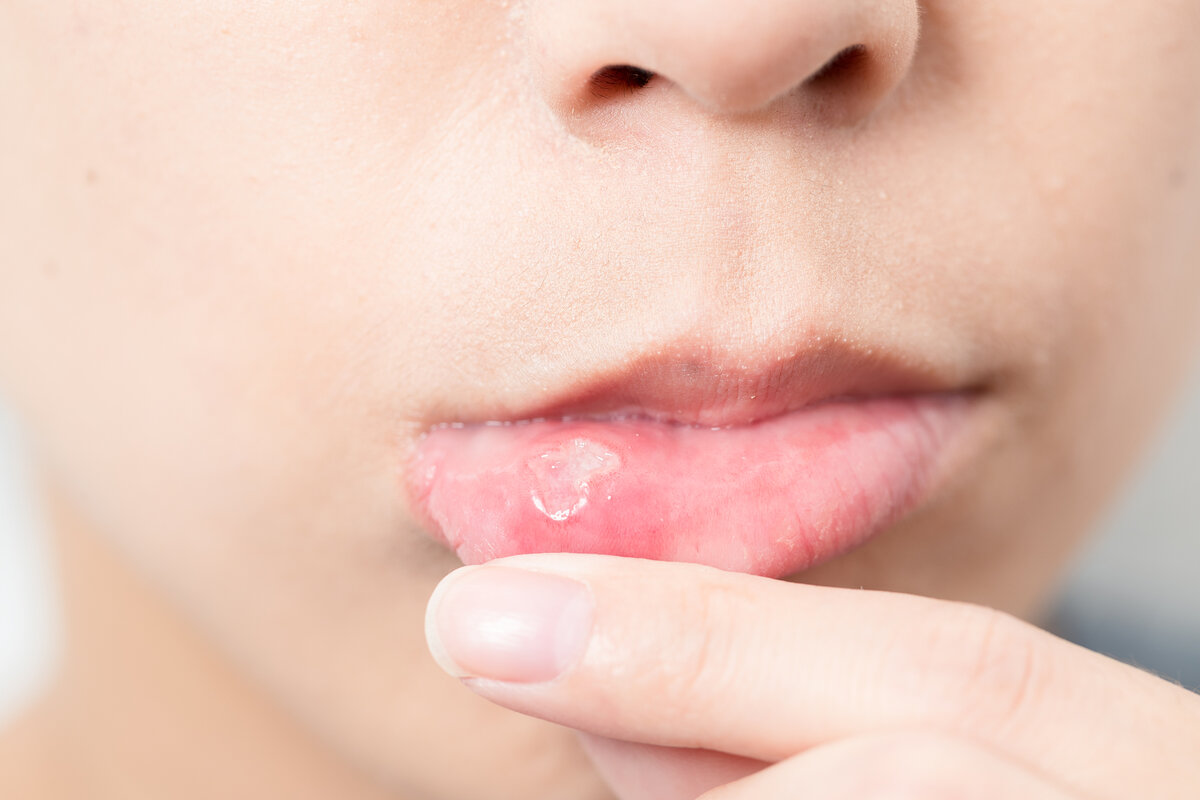 Тошнота, рвота и особенности ухода за полостью рта при химиотерапии