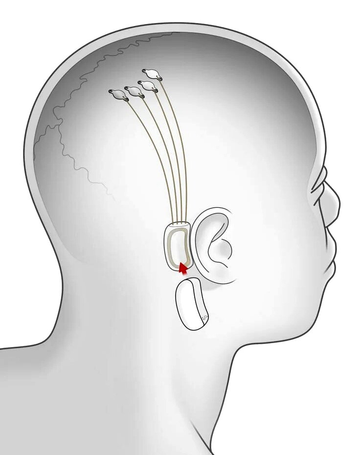 Изображение, на котором показан схематичный принцип подключения данного устройства к телу человека.