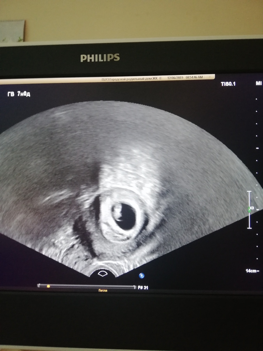 Первое УЗИ