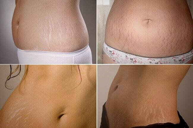 Растяжки как они есть