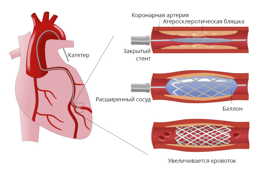 Рис. Стентирование коронарной артерии