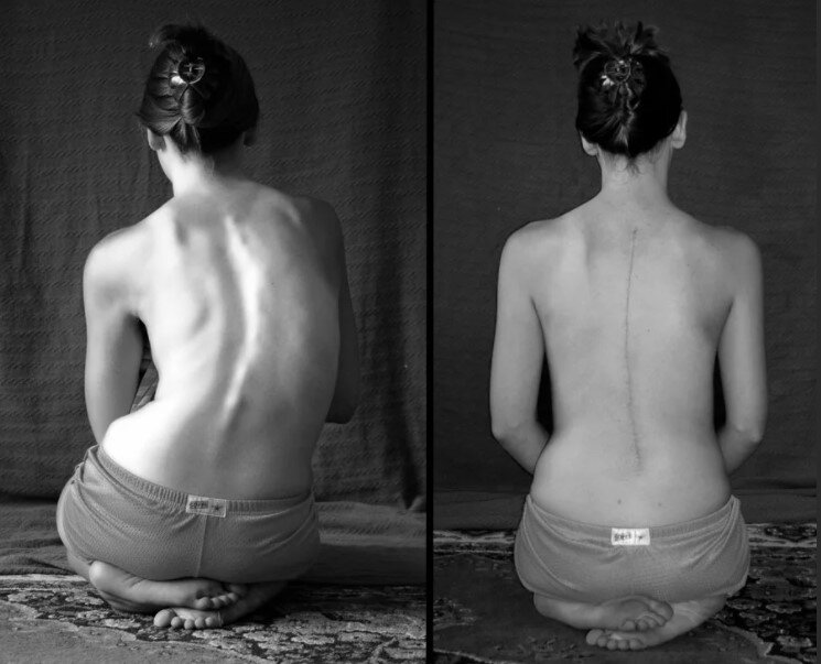 Можно ли исправить сколиоз?