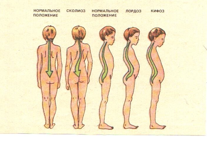 Как называется нарушение осанки изображенное на рисунке 3