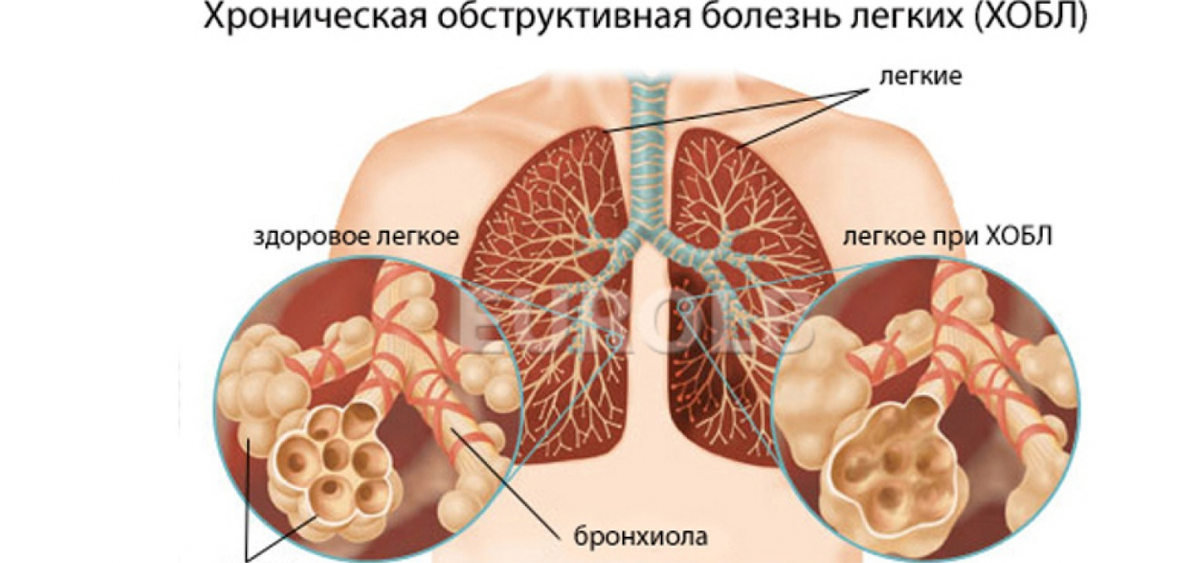 Diagnostic and curative bronchoscopy for purulent-destructive pulmonary diseases