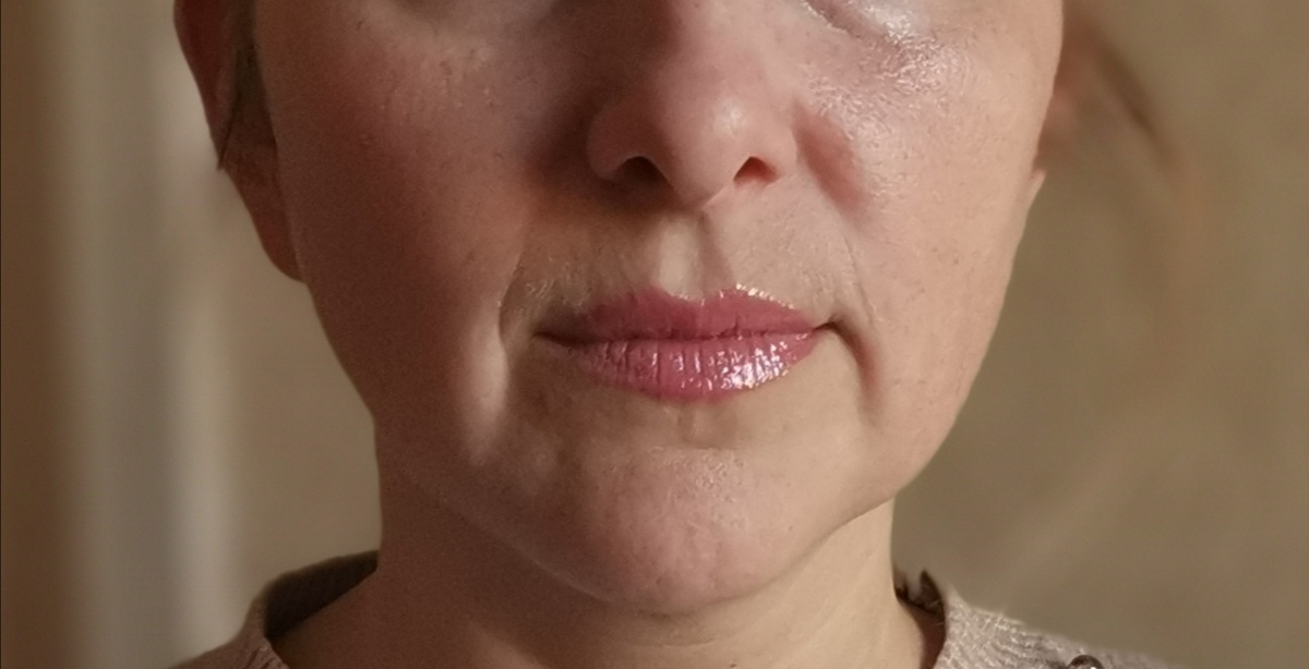 Мои основные жалобы были на сильно глубокие носогубные складки и начавшееся обвисание щёк(слышала, что некоторые называют это "брыльями") 