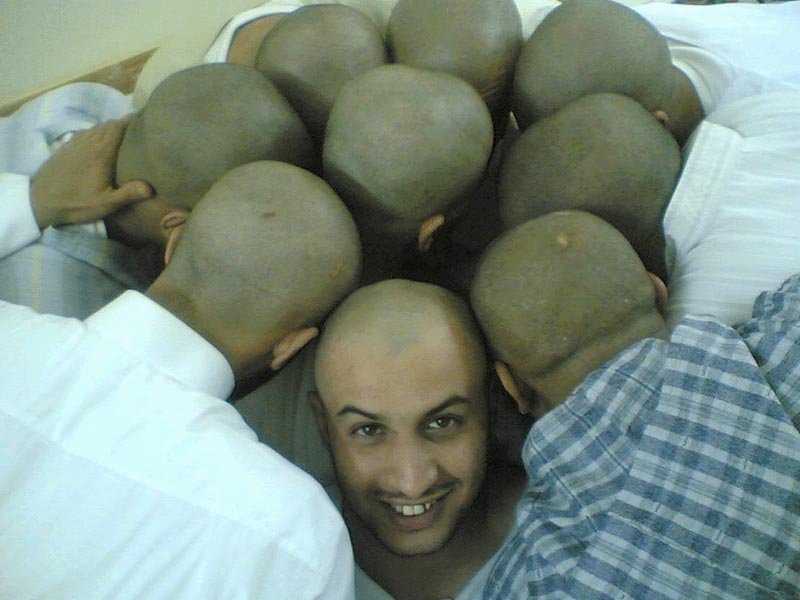 Вы думаете, облысение у сильной половины человечества начинается из-за нагрузок, стрессов и нервной работы? На самом деле, это не так. Чаще всего у лысеющего мужчины прическа начинает редеть в области висков, на лбу и темени. Это самый распространённый тип мужского облысения — андрогенетическая алопеция (далее — АГА). Она передаётся по наследству, а, значит, вылечить навсегда ее нельзя. Однако, не всё так печально. Давайте рассмотрим механизм АГА подробнее и узнаем, что именно можно (и нужно!) делать. АГА проявляется в высокой чувствительности волосяных фолликулов к выработке андрогенов (мужских стероидных гормонов) ДГЭА-с и ДГТ. Эта чувствительность передаётся генетически. Отсюда и название - «андрогенетическая». В норме эти гормоны регулируют процессы жизнедеятельности и влияют на физическое развитие. Но в организме, предрасположенном к АГА, они подавляют естественные процессы анагена. Питание волосяного фолликула нарушается, он атрофируется и перестаёт выращивать новые волоски, а затем - погибает.