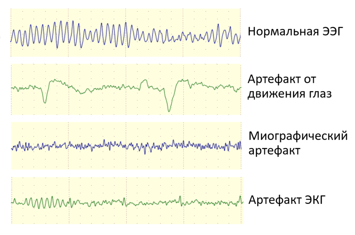 Нормальная ээг. Артефакт ЭКГ на ЭЭГ. Физиологические артефакты ЭЭГ. Двигательные артефакты на ЭЭГ. ЭЭГ запись.