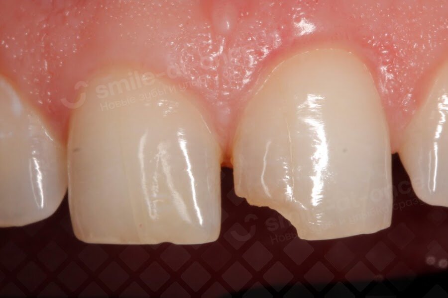 Сколы на резцах часто появляются, если разгрызать или поддевать зубами что-либо жесткое – скорлупу орехов, бутылочные пробки, нитки и др. Фото: Smile-at-Once.ru.