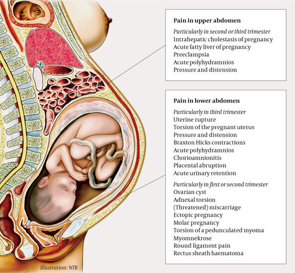 Твердый живот при беременности: физиология и патология