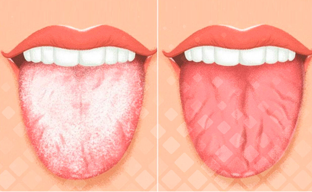 Симптомы кандидоза полости рта