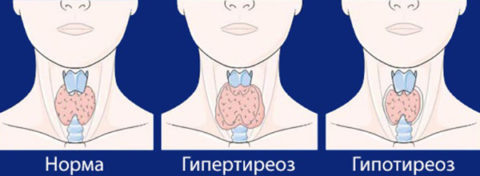 При заболевании гипотиреоз у мужчин – симптомы могут быть практически не выражены
