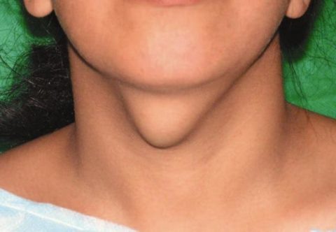  У женщин кисты щитовидной железы встречаются гораздо чаще, нежели у мужчин