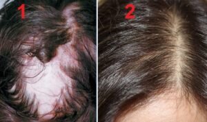 Существует два основных вида женской алопеции: