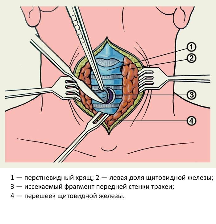 Трахеостомия техника выполнения в картинках
