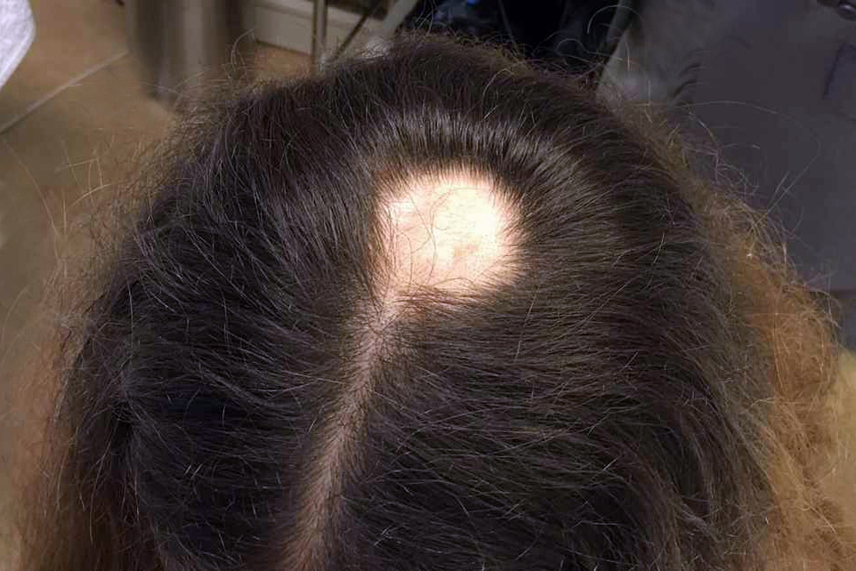 Очаговая алопеция у женщин