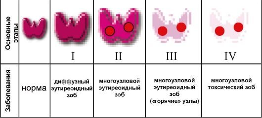 
Функциональная автономия щитовидной железы (ФА) - независимый от влияния тиреотропного гормона гипофиза (ТТГ) захват йода и продукция тироксина тироцитами. 1.	Унифокальная ФА (автономная или тиреотоксическая аденома).
2.	Мультифокальная ФА (многоузловой токсический зоб).
3.	Дисссеминированная ФА (диффузное распределение автономно функционирующих тиреоцитов в виде мелкоузловых ареалов).
Многоузловой (узловой) токсический зоб
В большинстве случаев является йододефицитным заболеванием, при котором стойкая патологическая гиперпродукция тиреоидных гормонов обусловлена формированием в щитовидной железе автономно функционирующих тироцитов. 
Йододефицитное заболевание и по сути – исход длительного, продолжающегося многие десятилетия, морфогенеза йододефицитного зоба

