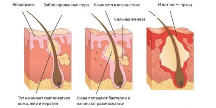                                                         Наглядное объяснение появления прыщей 