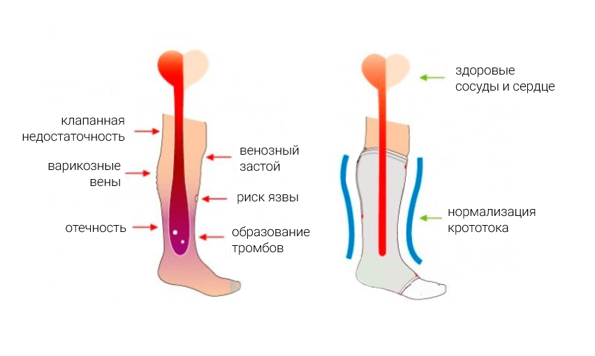 Сосуд ли. Механизм действия компрессионного трикотажа. Компрессионные чулки механизм действия. Механизм действия компрессионных чулков. Компрессионные трикотажи при болезни вен.