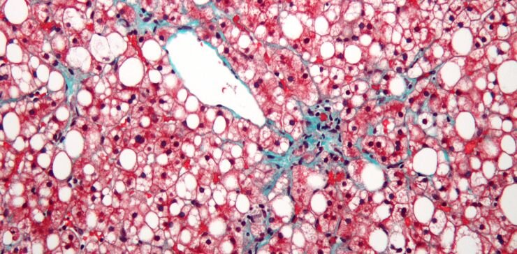 Неалкогольная жировая болезнь печени характеризуется накоплением капель жира (белый цвет) и умереннымй фиброзом (зеленый). Клетки печени – гепатоциты, окрашены красным