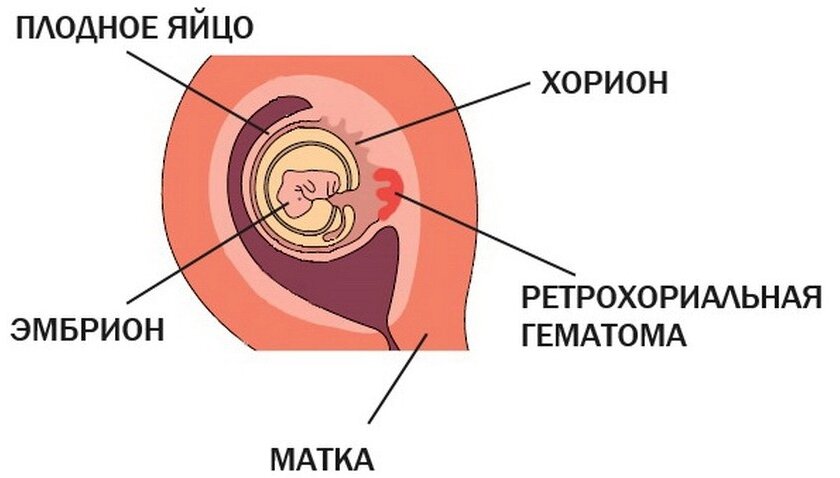 Гематома при беременности на ранних сроках. Ретрохориальная гематома у плодного яйца. Гематома на плодном яйце при беременности. Ретрохориальная гематома при беременности 7 недель.