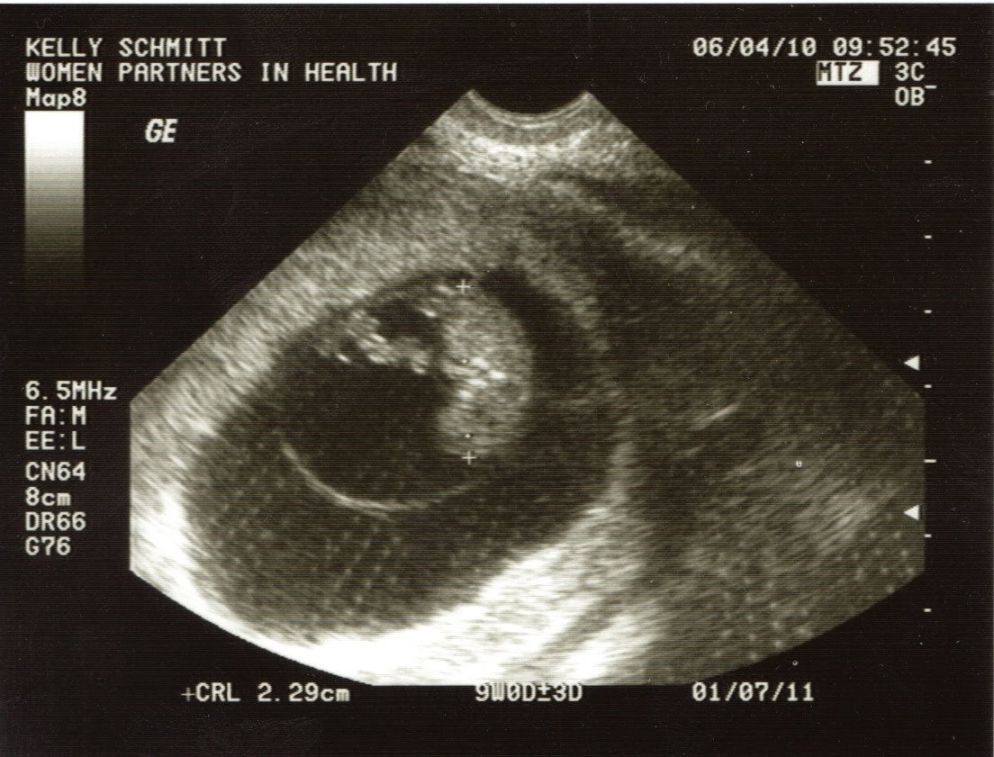 9 недель беременности размер плода. 9 Я неделя беременности УЗИ. УЗИ 9 недель беременности. УЗИ плода на 9-10 неделе беременности. УЗИ 10 недель беременности.
