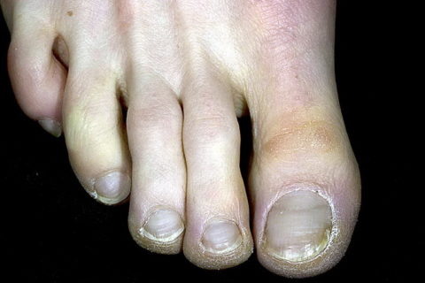  Кожные покровы бледнеют