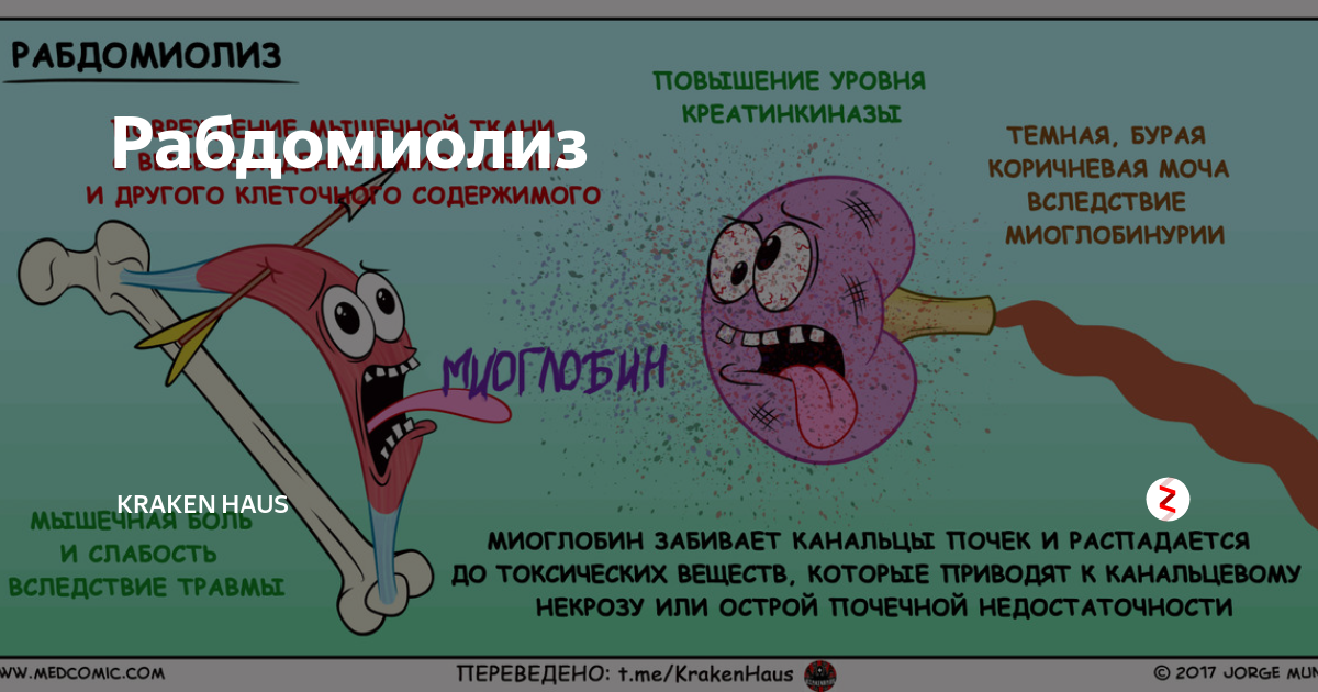 Рабдомиолиз что это. Раб дамиолис. Рабдомиолиз лекарства. Рабдомиолиз и статины