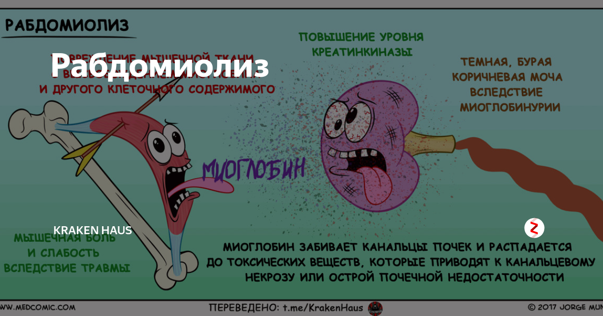 Статины рабдомиолиз. Рабдомиолиз. Рабдомиолиз механизм развития. Рабдомиолиз кожные проявления.