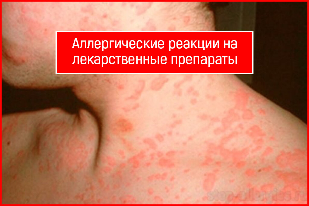   Аллергия на препараты Аллергическая  реакция на различные лекарственные препараты яв­ляется серьезной  клинической проблемой.