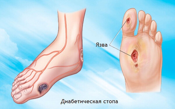 диабетическая стопа