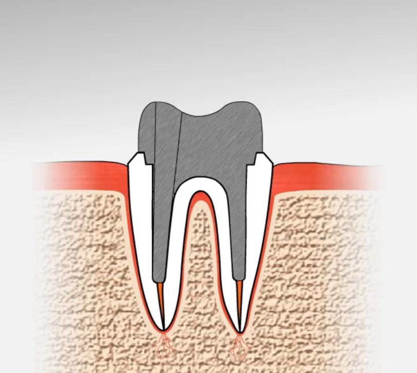 Сколько лет могут простоять современные коронки и вкладки на зубах?